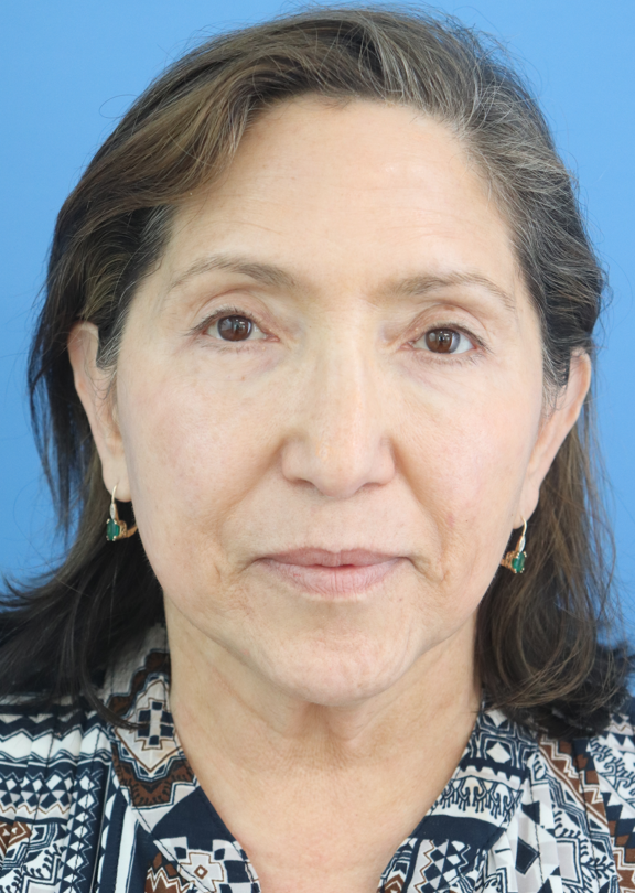 Facelift Before & After Gallery - Patient diFehSFNTWaHUy6bRecECQ - Image 3
